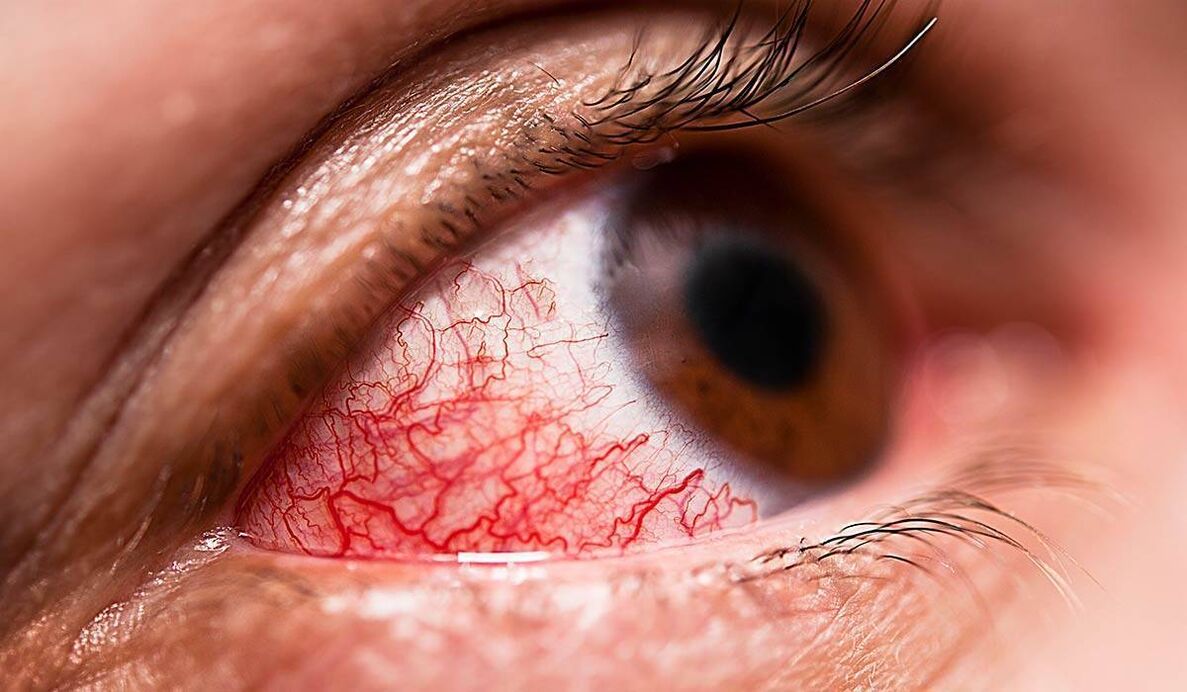 Diabetische retinopathie is een van de late complicaties van diabetes